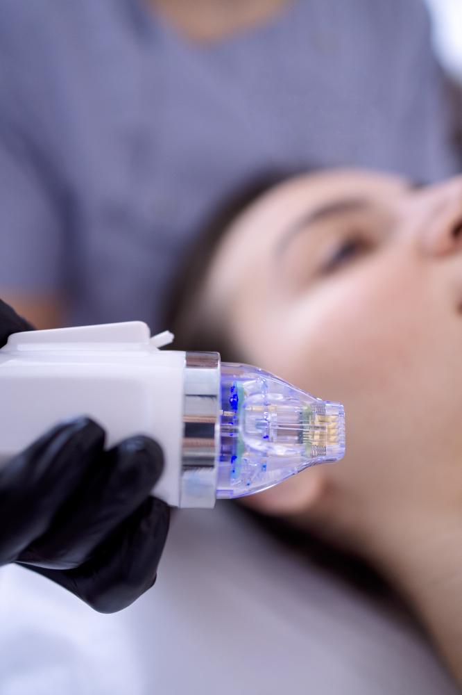 How Does Radio Frequency Microneedling Work?
