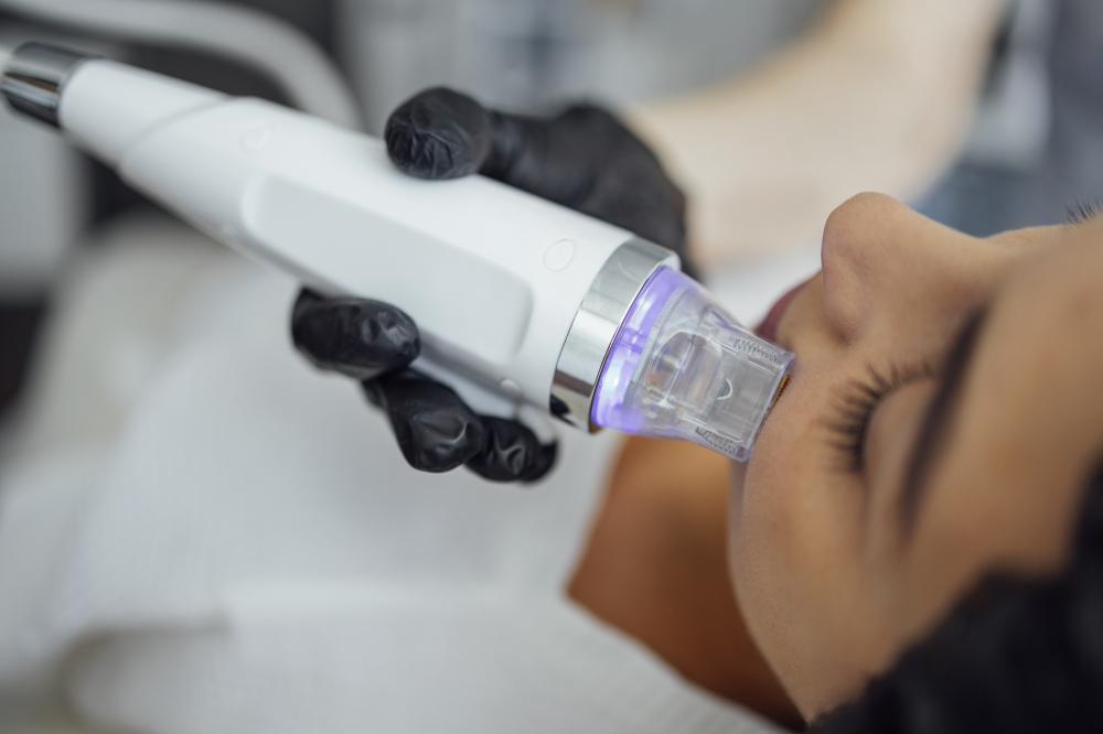 Why Is Micro Needling Trending in Charleston SC?