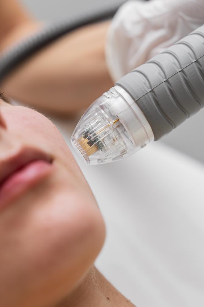 How Does Morpheus8 RF Microneedling Work?