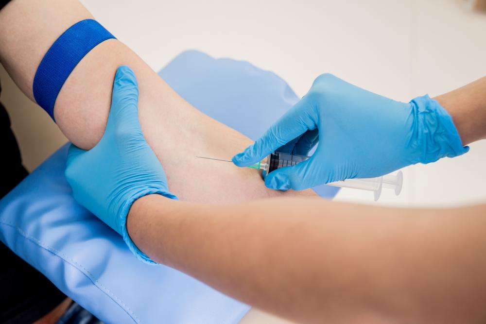 Benefits of Sclerotherapy