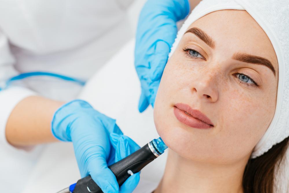 Benefits of RF Microneedling