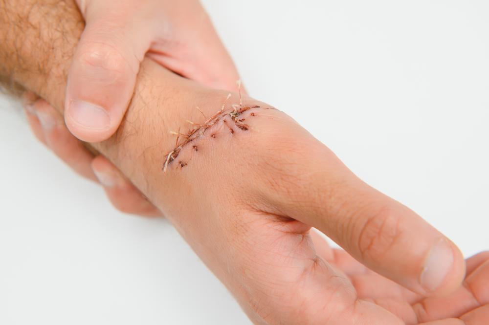 The Importance of Debridement in Wound Care