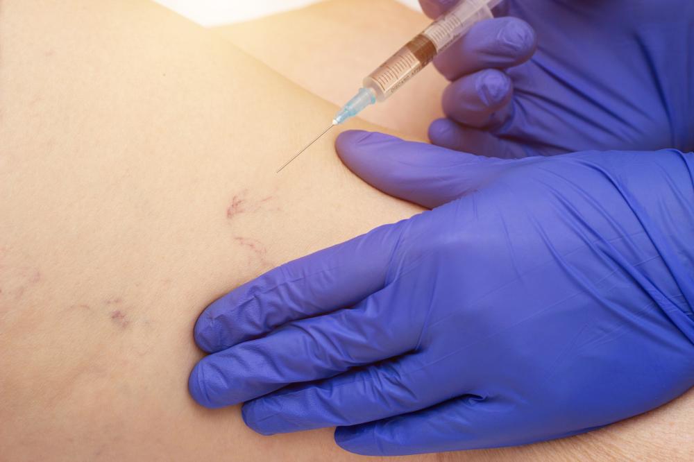 Why Choose Sclerotherapy for Varicose Veins?