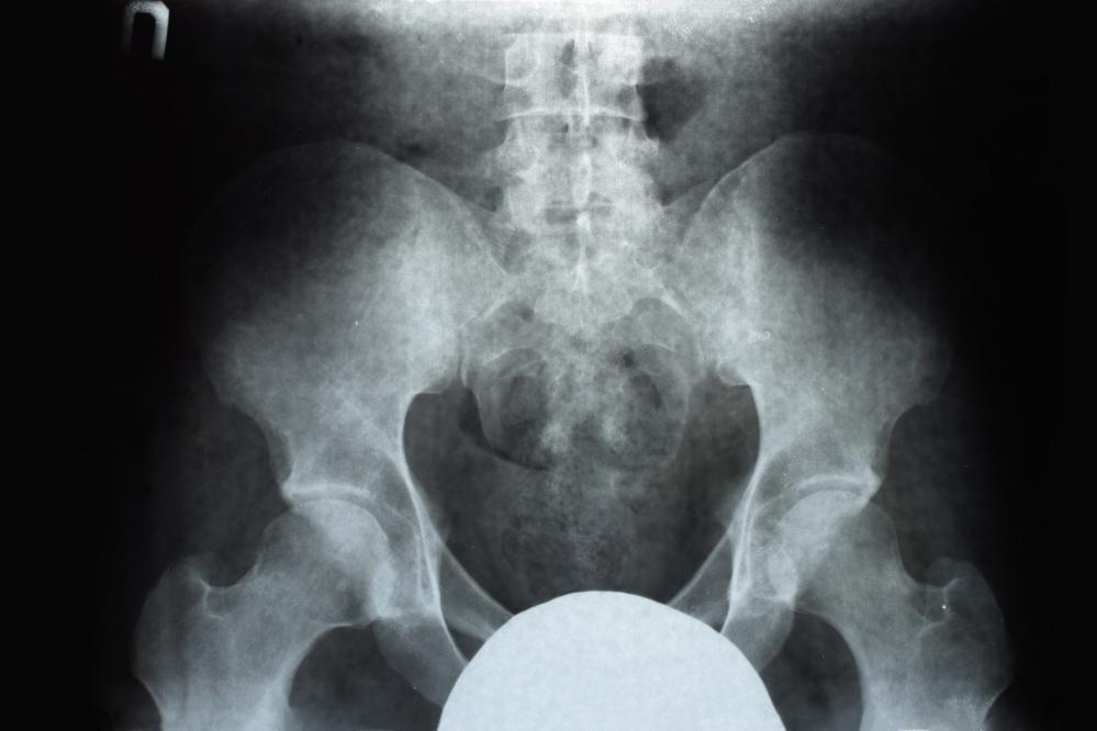 X-ray technology facilitating pediatric rectal prolapse surgery