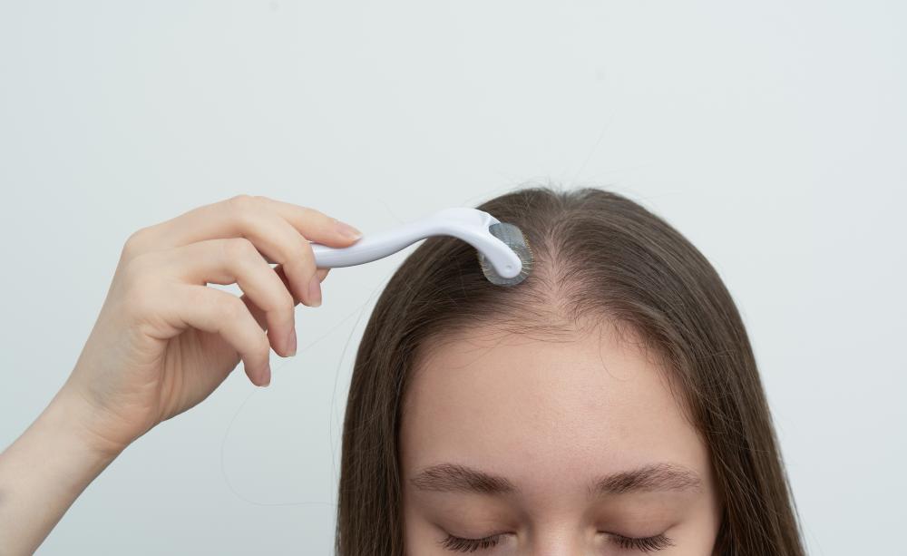 Why Choose Microneedling for Hair Loss?