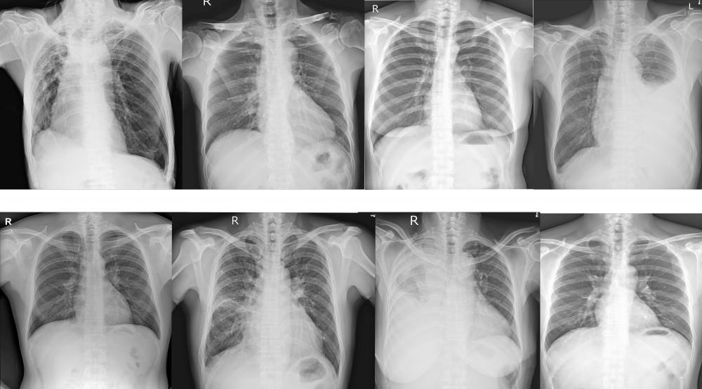 Types and Treatments of Pediatric Chest Wall Deformity