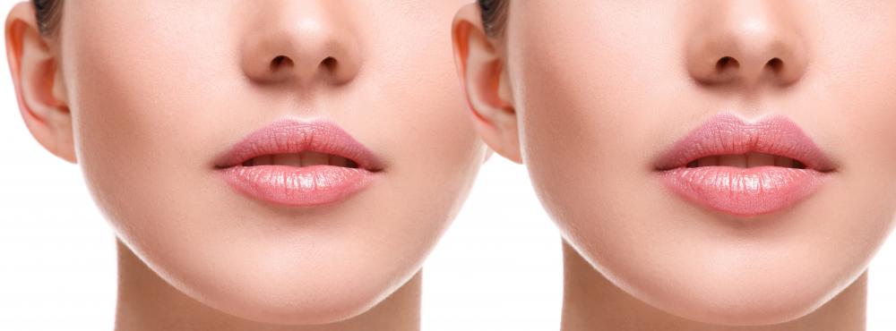 Smooth and youthful skin achieved through Juvederm treatments