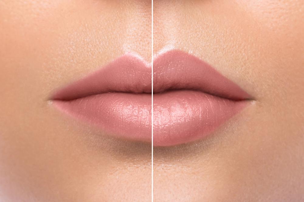 Artistic lip augmentation with fillers in Melbourne FL