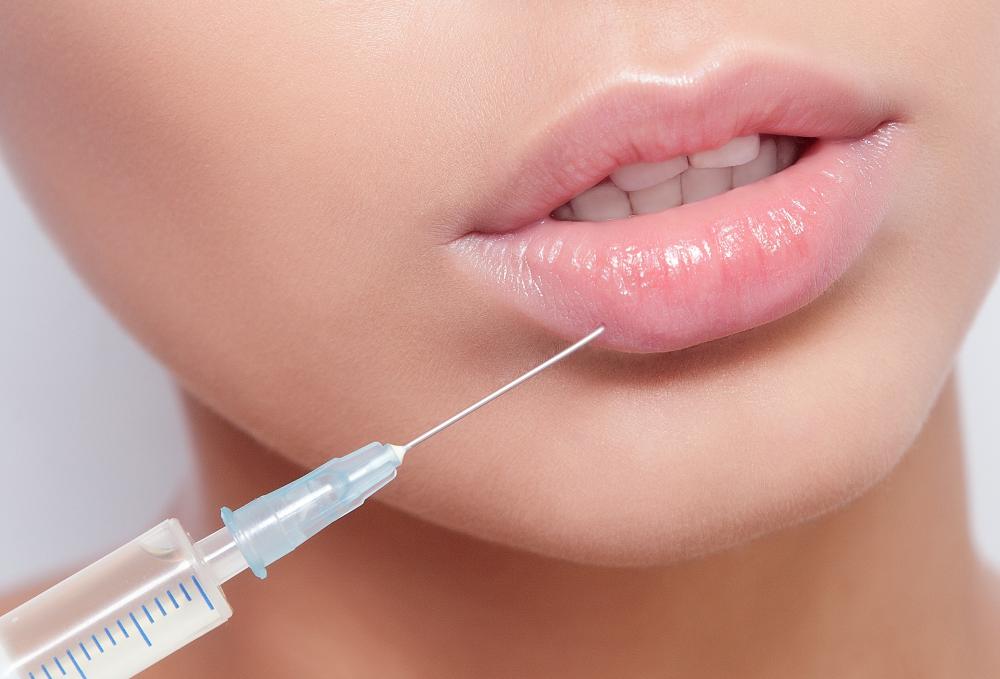 What to Expect from the Lip Injections Process