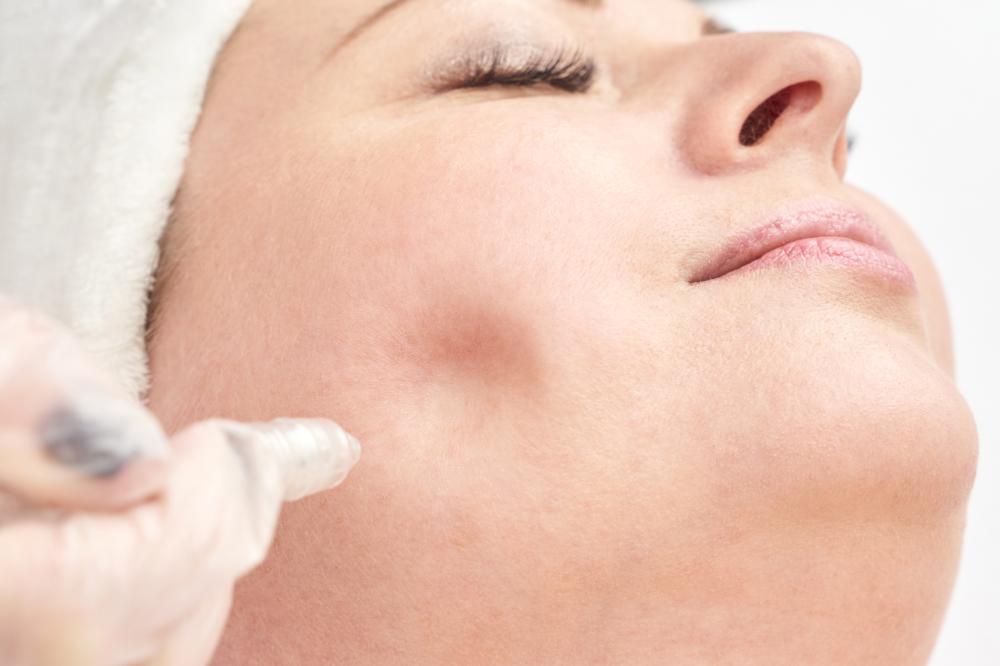 The Micro Needling Process