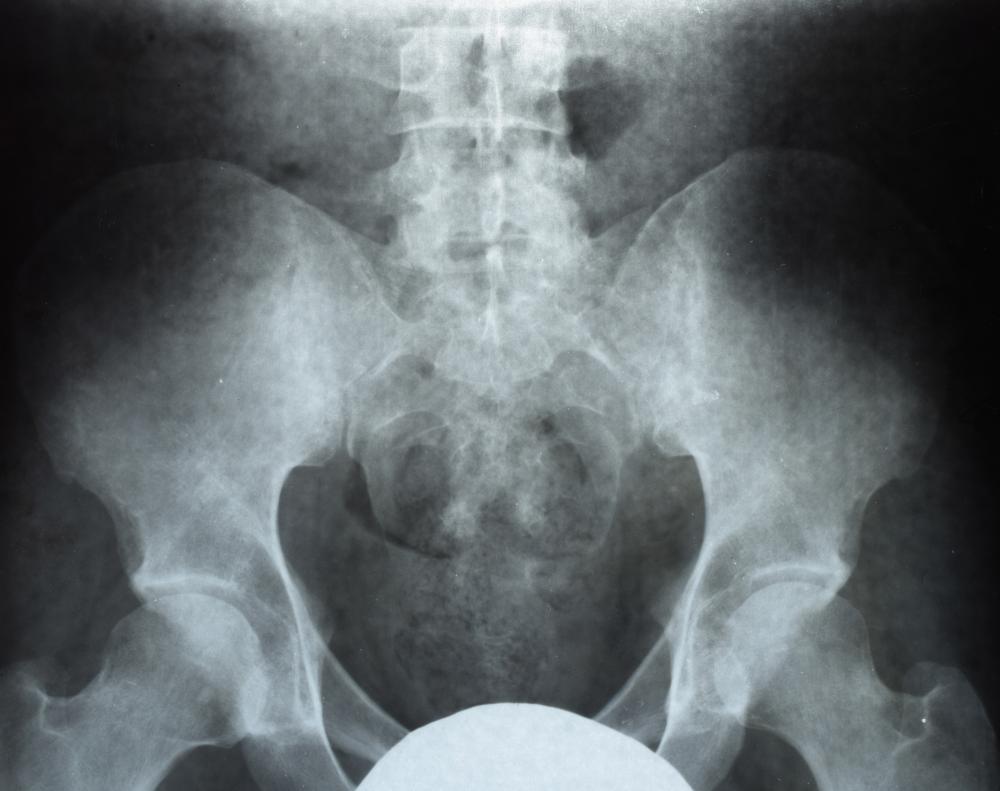 X-ray image aiding in understanding pediatric rectal prolapse
