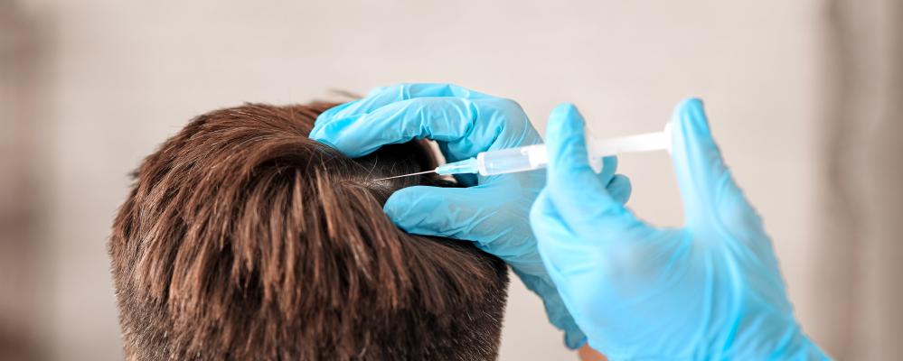 How Does Stem Cell Exosome Therapy For Hair Restoration Work?