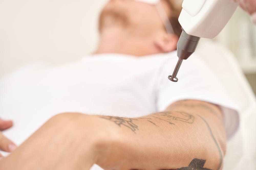 How Does Numbing Cream for Laser Tattoo Removal Work?