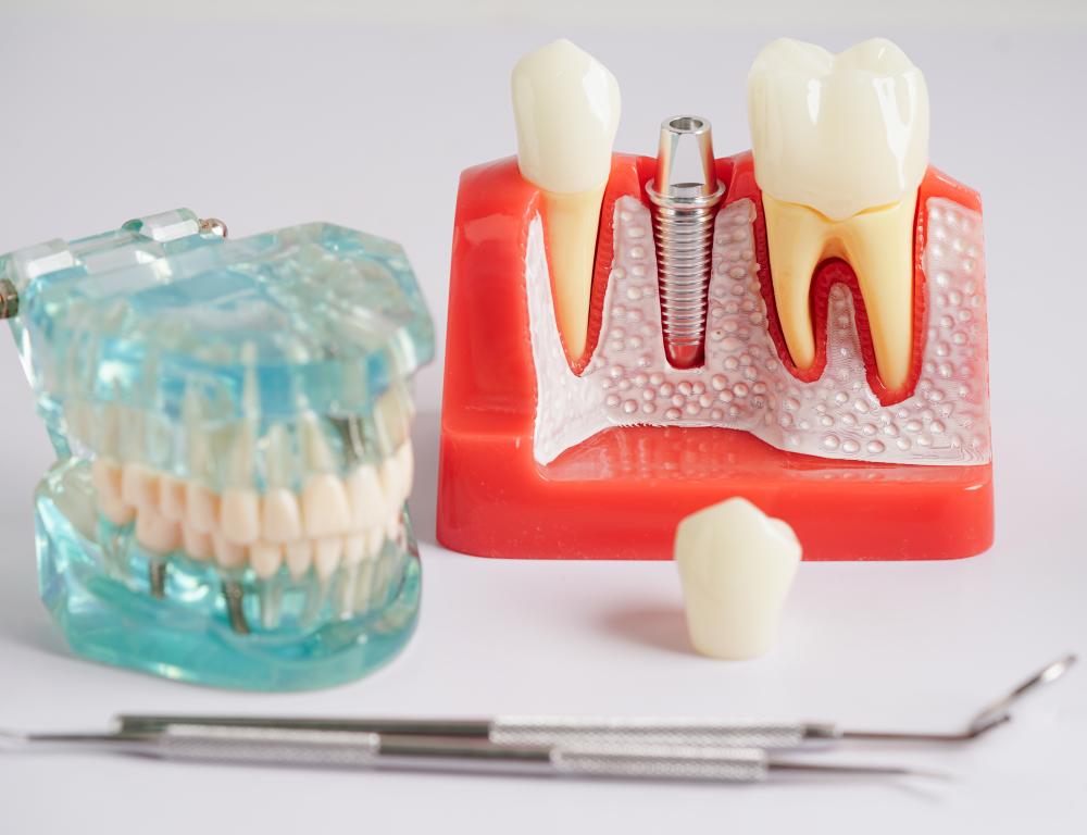 Detailed illustration of dental implant steps for patient education