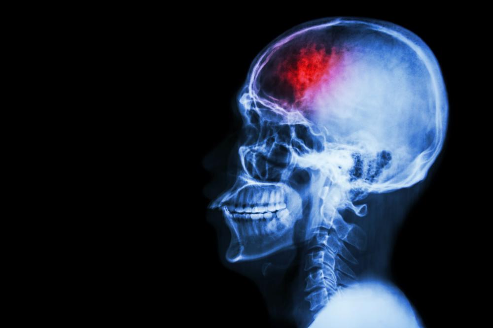 X-ray imagery of a stroke-related brain injury by a Houston attorney